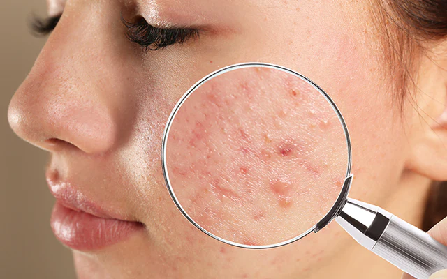 pimple pimple