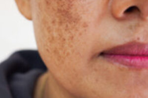 Best Guide to Melasma