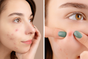 Acne Serums – The Ultimate Expert Guide