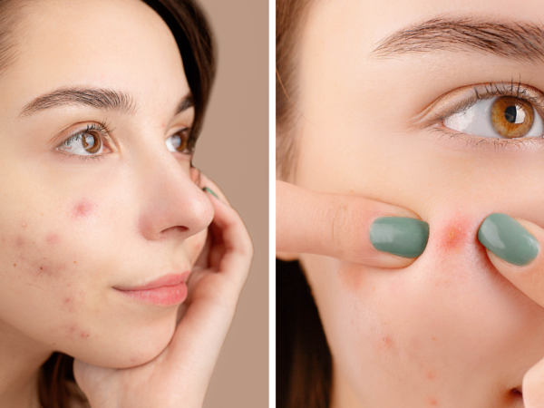 Acne Serums – The Ultimate Expert Guide