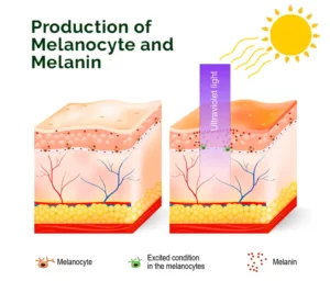 Melasma