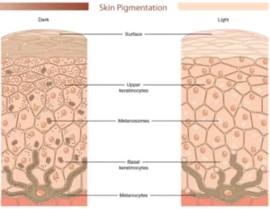 Melasma