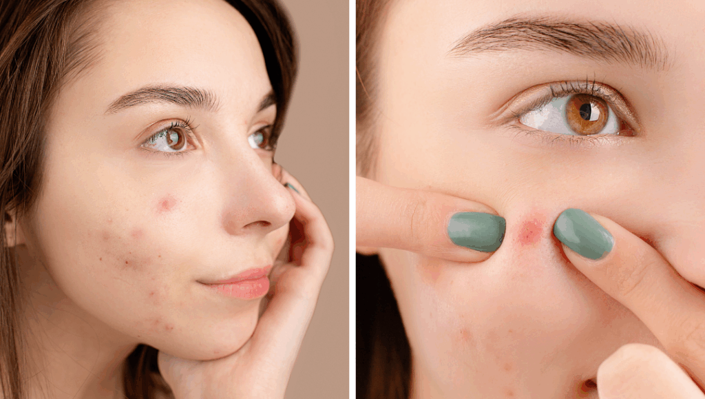 acne serum