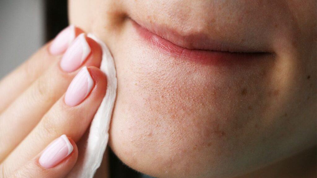 how to treat blackheads