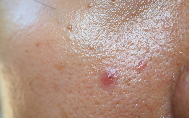 how to treat oily skin