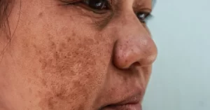 Melasma