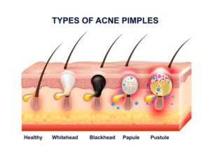 pimple Types of acne pimple lesions